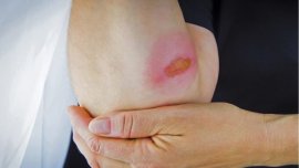 What you need to do when experience airbag explosion and get burned