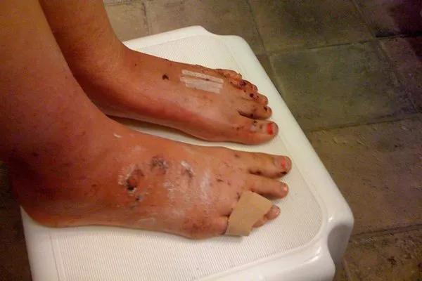 Injured feet